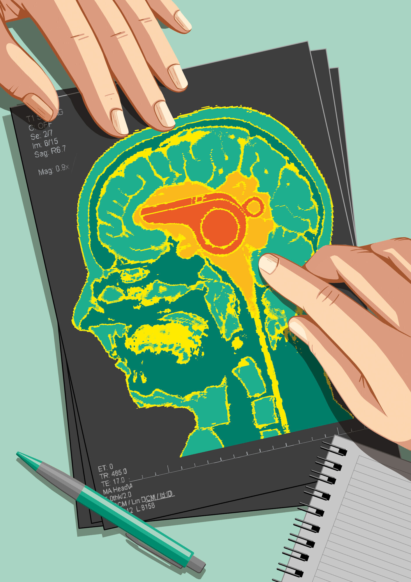 Die Illustration thematisiert Tinnitus, indem sie eine Pfeife im Gehirn darstellt. 